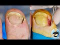 HE WAS TOLD HE DIDN’T HAVE AN INGROWN TOENAIL...WHAT DO YOU THINK???
