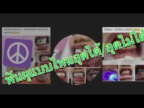 ฟันผุแบบไหนอุดได้แบบไหนอุดไม่ได้???