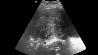 CASE 1012 sonohysterosalpingogram uterine fibriod