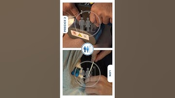 Distraction Process in LON Method - Precice 2 I Limb Lengthening