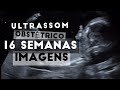 ULTRASSOM OBSTÉTRICO DE 16 SEMANAS - MOMENTO DE CALMARIA