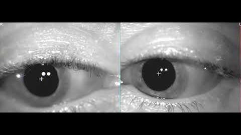 Identify This Rare Etiology in a Post-Trauma Patient