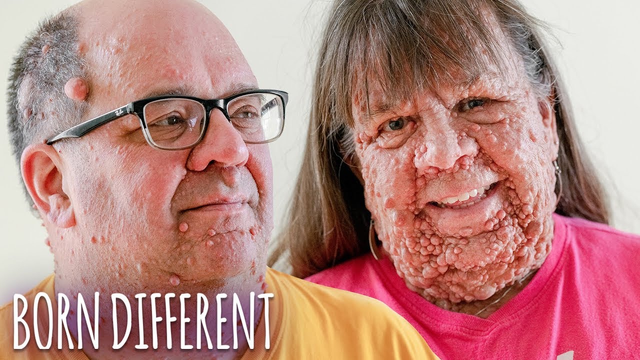 Husband & Wife With Thousands Of Tumours | BORN DIFFERENT