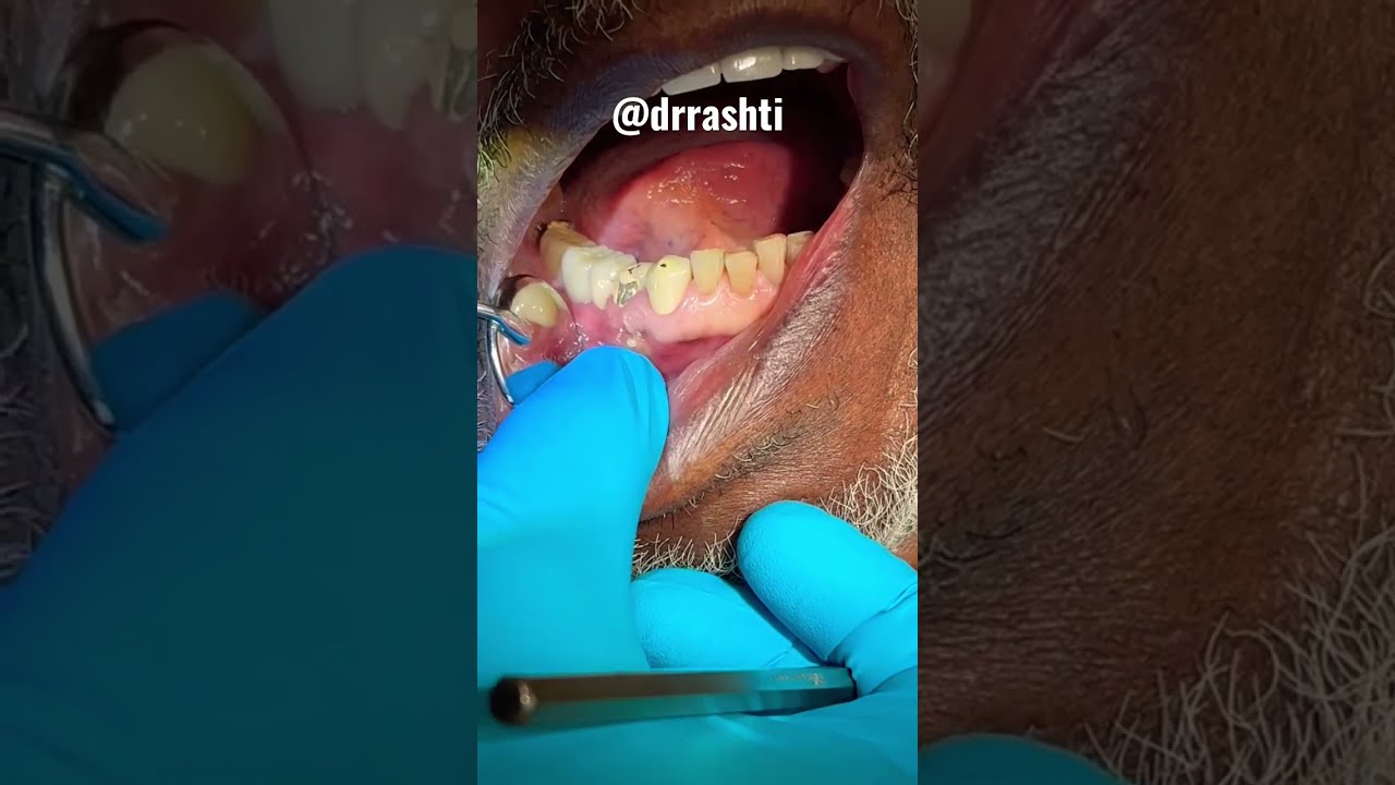 This Is What Periodontal Disease Looks Like Aka The Silent Killer See Your Dentist ASAP Shorts