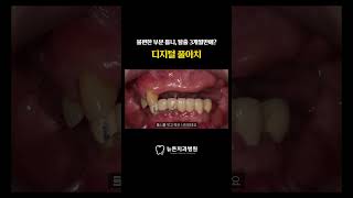 [부산전체임플란트] 불편한 부분 틀니, 탈출 3개월만에?  &quot; 디지털 풀아치 &quot; #shorts
