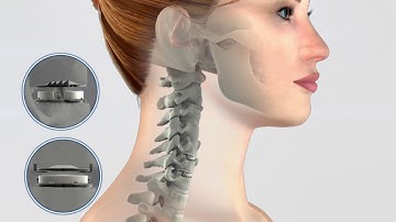 Cervical Disc Surgery - Mobi-C versus Fusion