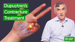 Treatment for Dupuytren’s Contracture | Surgical Options Explained by a Hand Specialist