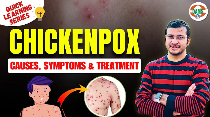 Chickenpox: Causes, Symptoms and Treatment | Quick Learning Series by Siddharth Sir | DAMS Nursing