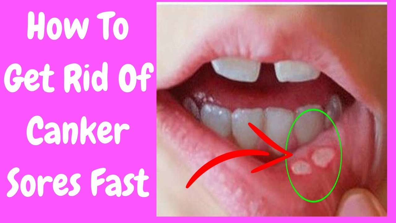 How To Get Rid Of Canker Sores Fast Can You Get A Canker Sore On Your