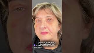 #beforeandafter #лифтингмосква #подтяжкалица #botox #доктор #пластическийхирург #makeup #smas