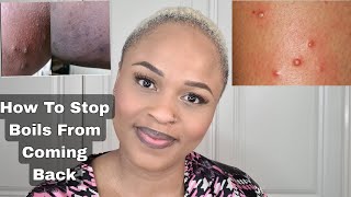 Tips To Stop Your Boils Coming Back Again