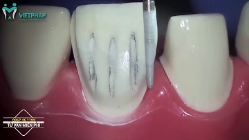 Kỹ thuật mài cùi răng sứ ĐẸP - CHUẨN XÁC - KHÔNG XÂM LẤN