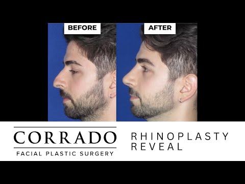 Video thumbnail: Droopy Tip Rhinoplasty Reveal 1 Week Post Op: "Wow! This Is Great!" – Before & After Photos · Dr. Anthony Corrado