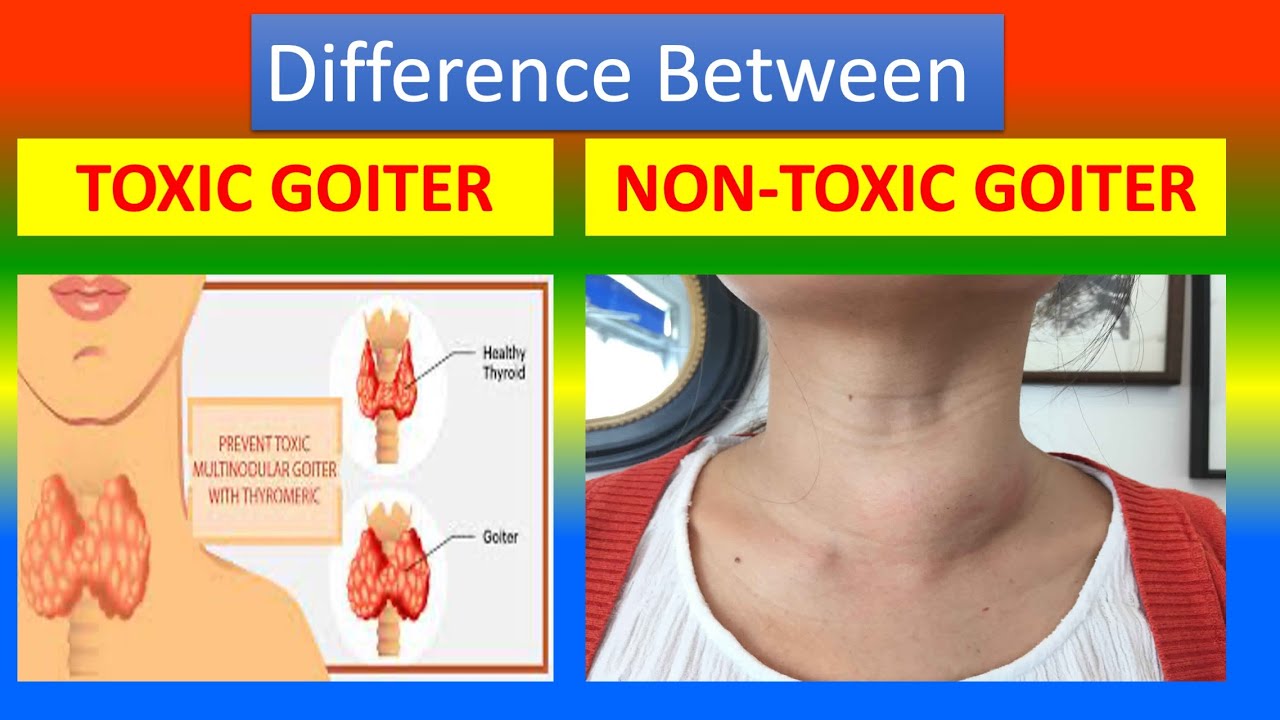 Difference Between Toxic Goiter And Nontoxic Goiter Youtube