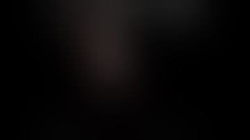 PCNL IN CROSSED RENAL ECTOPIA FOR 25 mm PELVIC CALCULUS BY DR HARSHAWARDHAN TANWAR