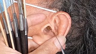 Earwax || Vệ sinh tai tại Vietnam (mùa covid 19)