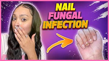 How I got a nail fungal infection...and treated it