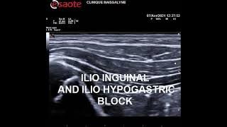 ILIO INGUINAL AND ILIOHYPOGASTRIC BLOCK