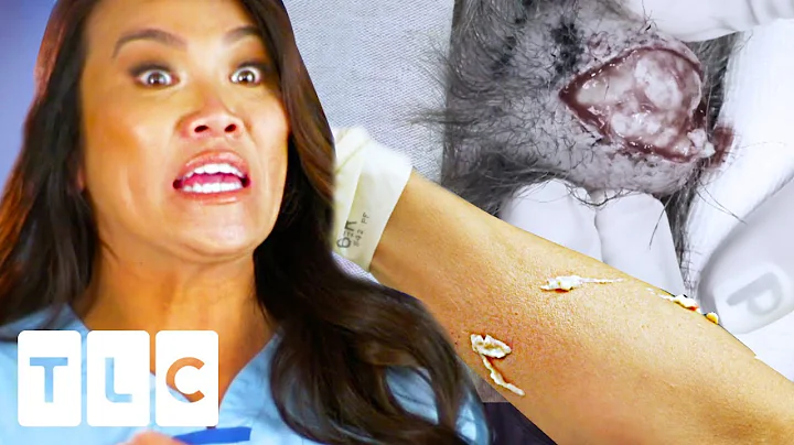 "Oh My God!": A Massive Pilar Cyst Explodes On Dr ...