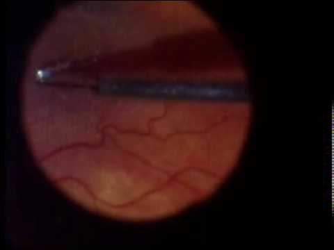 Peeling a tenacious epiretinal membrane. Utilized a dilute triamcinolone solution to stain the membrane, then a pinch-and-peel technique with 23G end-grasping ILM forceps to remove the membrane.