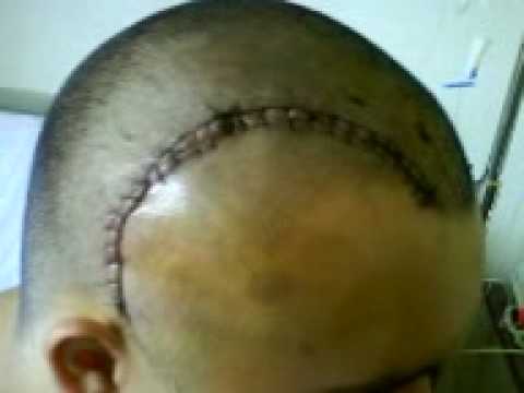 hematoma en la cabeza operacion hematoma en la cabeza operacion