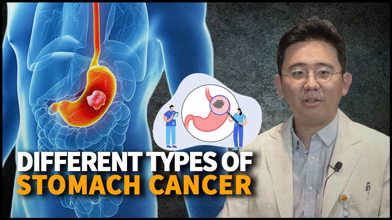 Different types of Stomach Cancer, Causes, Symptoms and Preventions