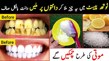 How To Whiten Teeth At Home | Teeth Whitening Home Remedy | Dant Saaf Karne Ka Totka