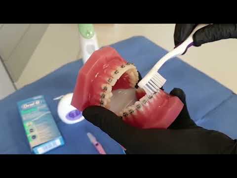 Video: 5 moduri de a curăța aparatele dentare