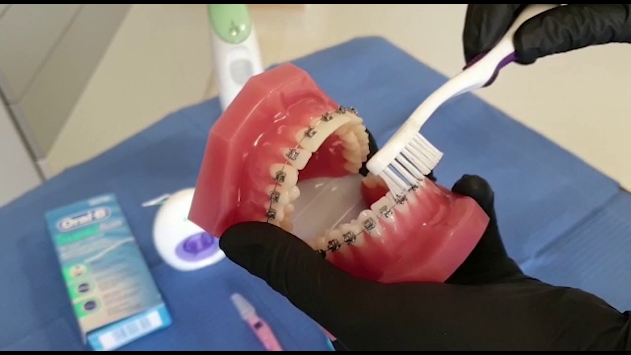 Cum sa ne curățam corect dinții când avem aparat dentar?