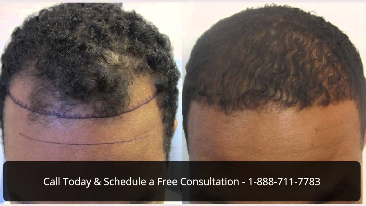 Best Hair Transplant Scar Repair Virginia Surgical Center YouTube