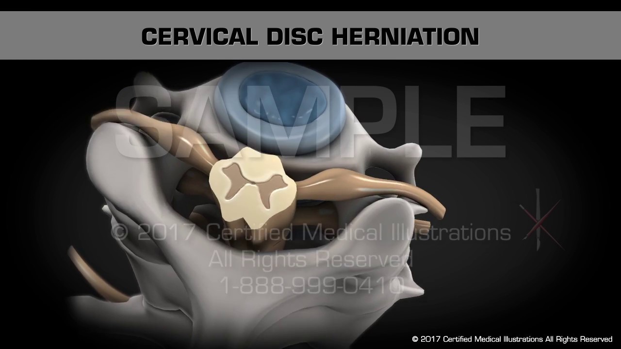Cervical Disc Herniation camera iphone 8 plus apk