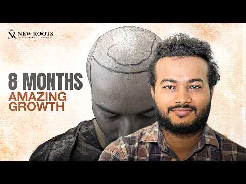 Grade 6 Baldness Gone? 😍 | Hair Transplant in Chhatrapati Sambhajinagar | Aurangabad
