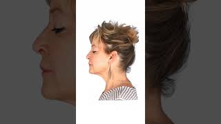 AMAZING TRANSFORMATION NECK AND FACE LIFT PLASTIC SURGERY  #doctor #cosmeticsurgeon #cosmeticsurgery