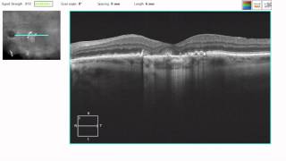 OCT Tutorial: Geographic Atrophy in Dry AMD