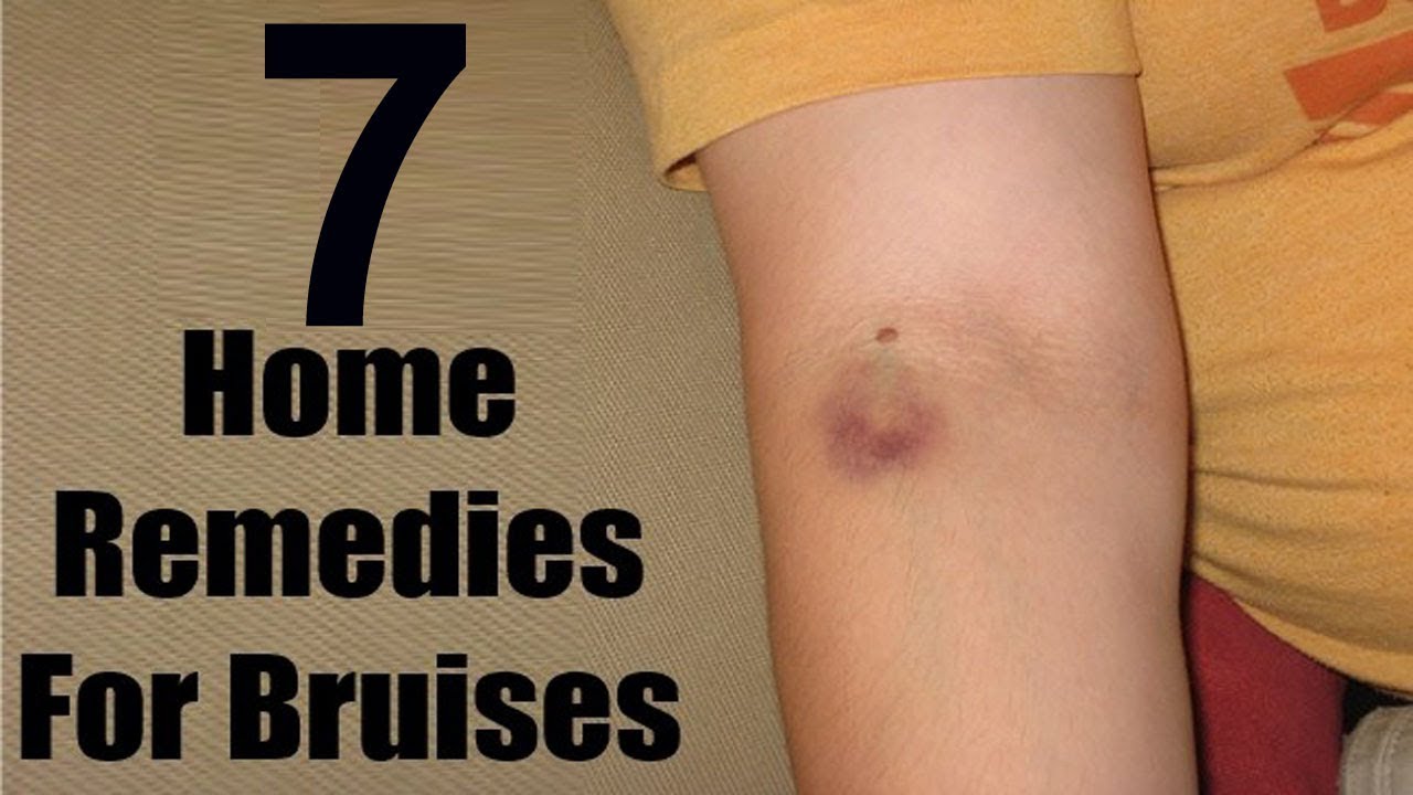 The Top 7 Home Remedies For Bruises Get Rid Bruiese Youtube