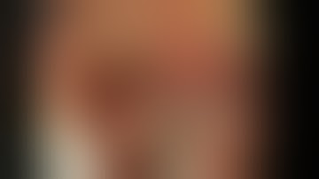 Prophylactic clipping before resection of a pedunculated polyp