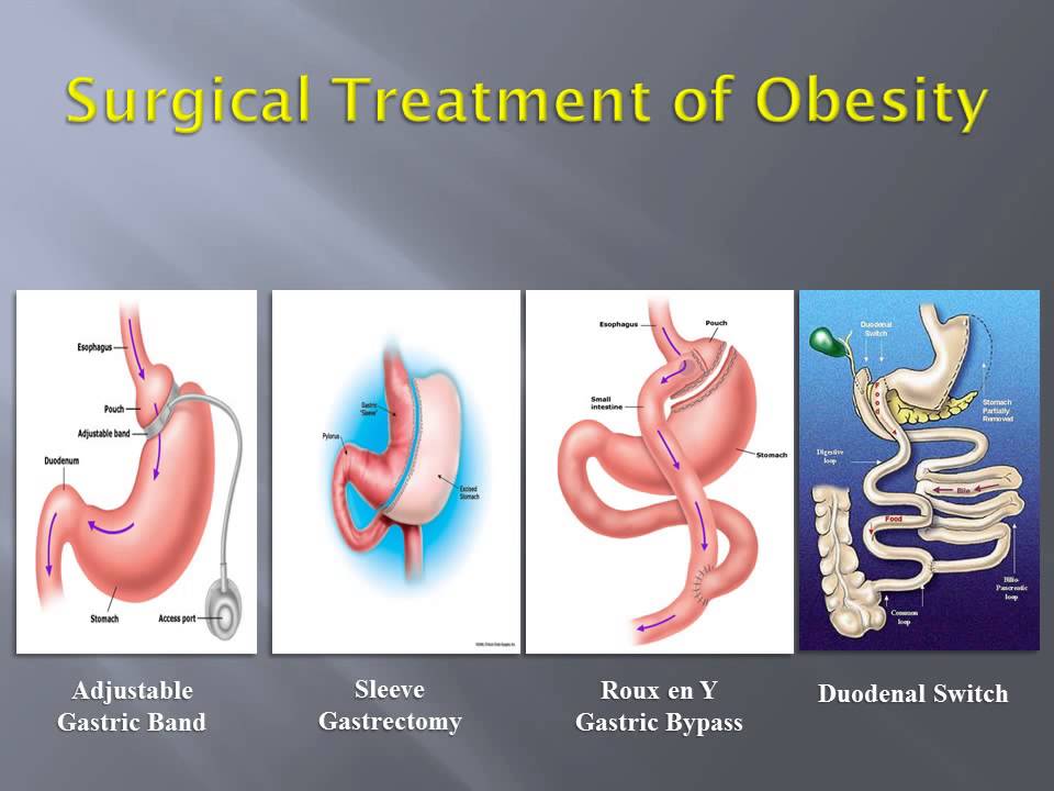 Houston Bariatric Surgery YouTube