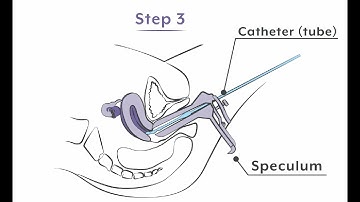 A step-by-step video to understand the Foam procedure (HyFoSy)