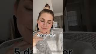 Watch The Progression From Day 1 To Day 7 First Time Getting Botox In My Forehead