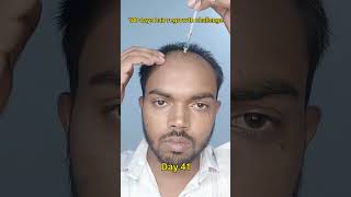 Day 41 | 180 days hair regrowth challenge #manmatters #shorts #shortsvideo