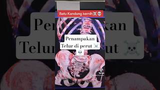 Telur Di Kandung kemih 💀☠️ #batukandungkemih #urology #infokesehatan #anatomy #fyp #ctscan #viral
