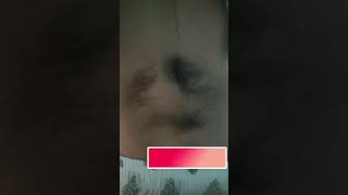 Patch of Hair on Lower Back? Hidden Sign of Spinal Dysraphism
