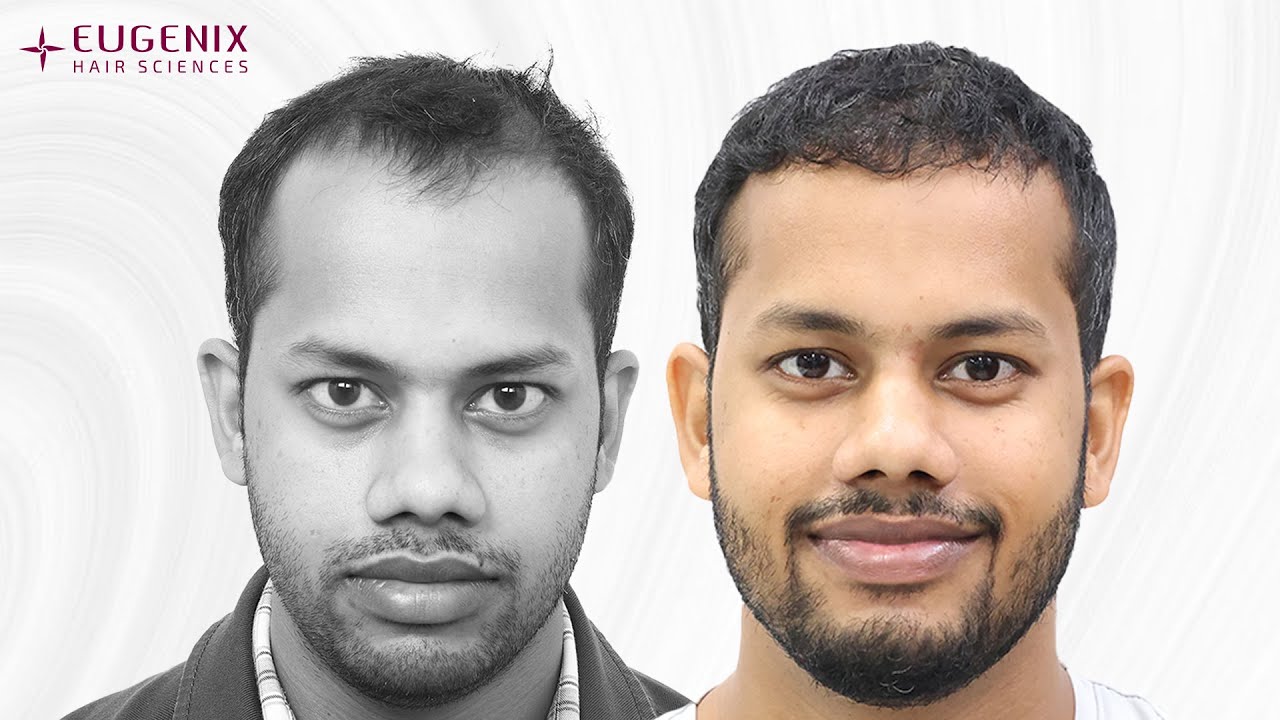 Natural Hairline After A Hair Transplant With Eugenix Hair Sciences