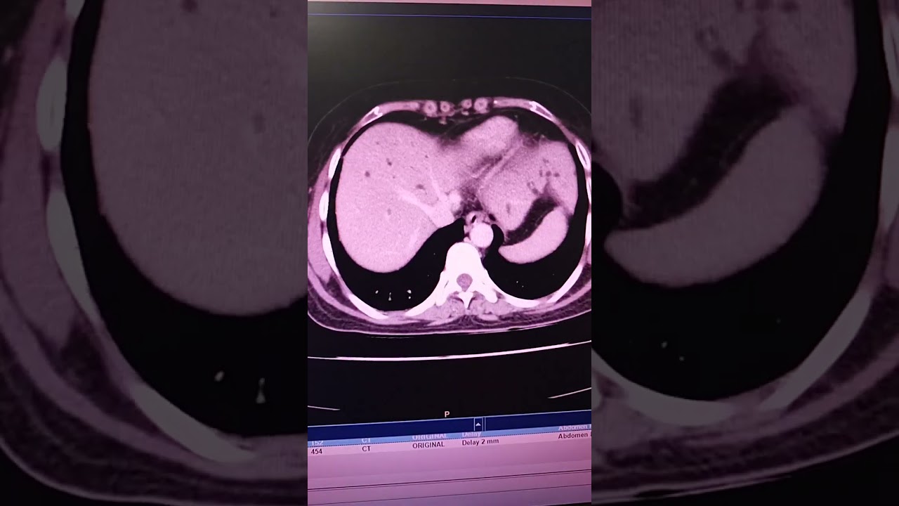 Triphasic Abdomenal CT Scan axial orientation 25 Year olad