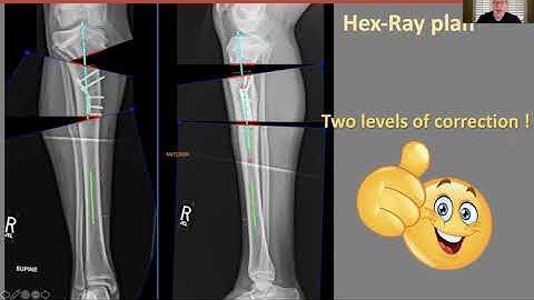 Pre operative planning for Deformities