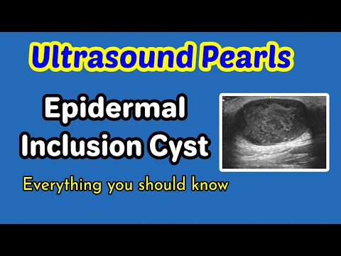 Ultrasound Pearls: Epidermal inclusion cyst