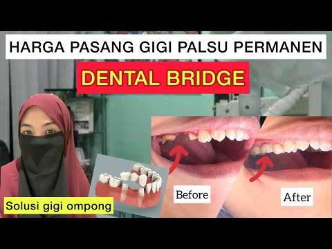 Video: Mengapa mereka memasang kembali gigi palsu?