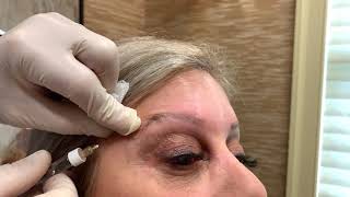 Filler Browlift [Instant Browlift without Surgery]