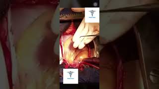 ‏ازالة جلطة صغيرة من الشريان التاجي .‏Removing a small clot from the coronary artery of the heart ‏