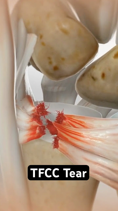 Wrist pain could be a tear (3D Animation)